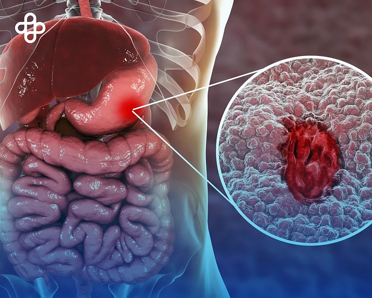 Tratamiento de la Gastritis