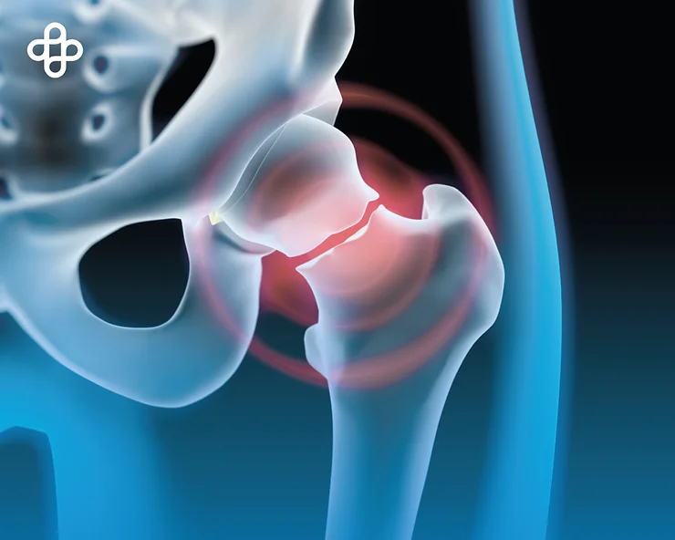 Síntomas de la osteoporosis